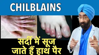 Chilblains : सर्दी में सूज जाते हैं हाथ पैर | Swollen hands and fingers in Winter | Dr.Education