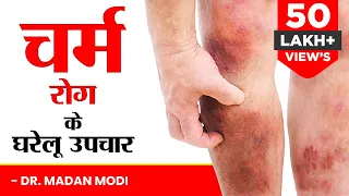 चर्म रोग के घरेलू उपचार | दाद, खाज-खुजली, एग्जिमा मिटाएं | home remedies for skin diseases |