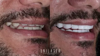 porcelain veneers | Carillas en porcelana