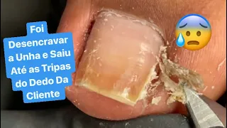 DESENCRAVEI O DEDÃO E SAIU ATÉ AS TRIPAS DA CLIENTE.VÍDEO Satisfatório