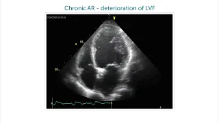 What are the consequences of significant aortic regurgitation?