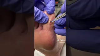 How to Remove Painful Seed Corn and Callus (Hard Skin) By an Australian Podiatrist