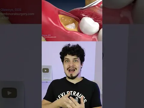 ASSIM QUE É UMA RETIRADA DE SISO