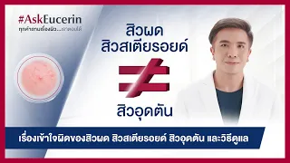 เรื่องจริงของสิวผด สิวสเตียรอยด์ และ สิวอุดตัน ต่างกันยังไง? พร้อมวิธีดูแลแบบผู้เชี่ยวชาญ
