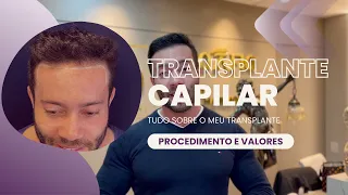 Tudo sobre o meu Transplante Capilar. Cabelo Vin Diesel nunca mais!