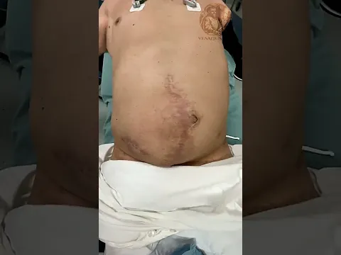 HERNIA