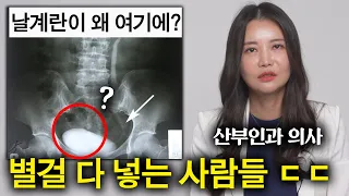 산부인과 의사를 놀라게 만드는 환자들 (별게 다 나옴 ㄷㄷ)