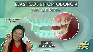 Elásticos en Ortodoncia 😬 ¿Para qué sirven? ¿Cómo funcionan? - Odontología Láser 🦷