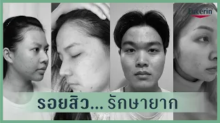 ไม่ต้องรออีกต่อไป...รอยสิวจัดการได้ ด้วย Eucerin Pro ACNE Solution Anti-Acne Mark Serum