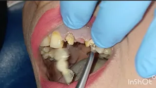 Smile correction befor and after 