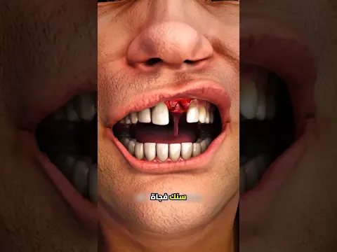 وقعت سنك؟ لا تعمل هذا الخطأ!😔😨