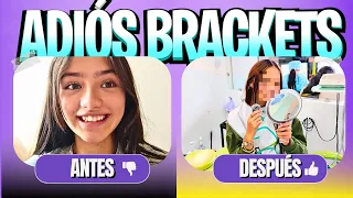 Todo mi proceso con brackets de principio a fin 😱 Vlog
