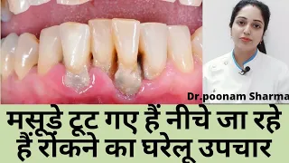 मसूड़े नीचे जा रहे हैं रोकने के घरेलू उपचार ||Home Remedies for Gum Recession||receding gums remedy