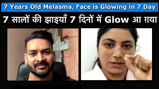 7 सालों की झाइयाँ 7 दिनों में Glow आ ग़या. 7 Years of Melasma, Face is Glowing in 7 days