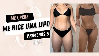 PRIMERA SEMANA DE MI CIRUGÍA - me hice una Lipo 😭