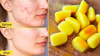 Ice Cubes For Spotless, Acne & Pimple Free Skin. Turmeric Ice Cubes For Glowing Skin