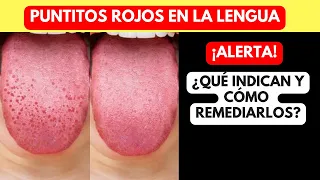 RED Dots on the TONGUE: What Do They Indicate and How to Treat Them?