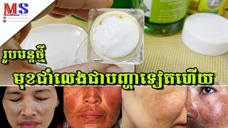 ជាំឈាម ជាំថ្ងៃ ជាំមានកូន ជាំដោយសារលាបម្សៅ អាចសាកល្បងជាមួយរូបមន្តថ្មីនេះបាន ប្រើបានគ្រប់ភេទ