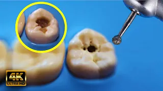 IMPRESIONANTE caries siendo removida en GRAN aumento 4k