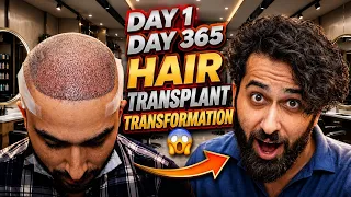 FUE Hair Transplant Timeline I Day 1 to Day 365 I Before & After | Born Creator