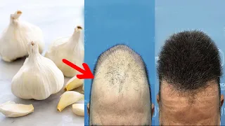 ضعها لفرغات شعرك و الصلع وأقسم بالله النتيجة ستبهرك تنبت الشعر وتملأ الفراغات من أول استعمال