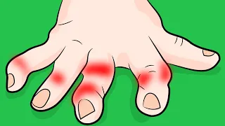 How to Stop Rheumatoid Arthritis in Your Fingers FAST!