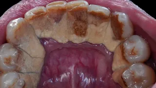 45 yo. Male. Giant Tartar | SCALING | Dentist | Dokter Gigi Tri Putra