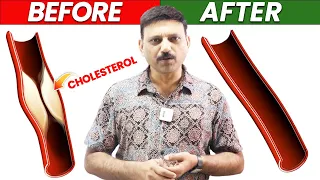 CHOLESTEROL को कुछ ही दिनो में पिघला देगा आयुर्वेद का ये करिश्माई चूर्ण | Manas Samarth