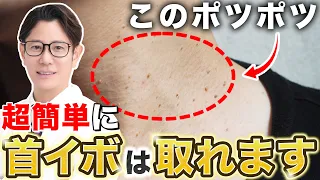 首のイボを簡単に取る方法を解説