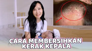 Cara Membersihkan Kerak Kepala atau Cradle Cap Ketombe Pada Bayi Baru Lahir