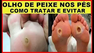 Remédio Caseiro Para Olho de Peixe  Natural, Rápido e Fácil!
