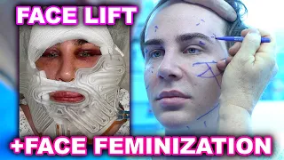 Meine FACE LIFT & FACIAL FEMINIZATION SURGERY (FFS) | Operations Vlog