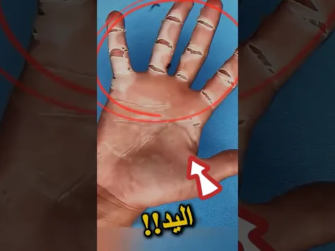 ما الذي يحدث ليد هذا الفتي! 😱🤯