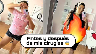 BBL Recuperación | Primera semana después de mi Lipo 360 | Que tanto duele |  BBL Experiencia |