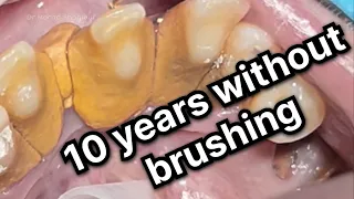 10 YEARS WITHOUT BRUSHING TEETH