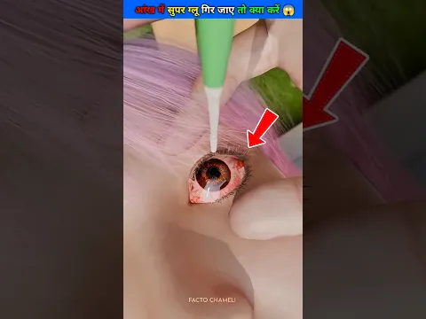 Accidentally Got Super Glue in Your Eye What to Do? 😱