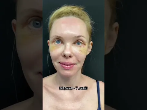 Как меняется человек 😍благодаря круговой блефаропластики и малярному липолизу. Доктор АБРАМЯН С.М.