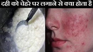 रोज चेहरे पर दही लगाने से पहले ये विडियो जरूर देख लेना