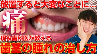 【歯医者が教える】歯茎の腫れの治し方！原因は7つの〇〇です。