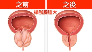 攝護腺腫大(前列腺腫大),每天喝一杯飲料,自然療法,柏格醫生 Dr Berg