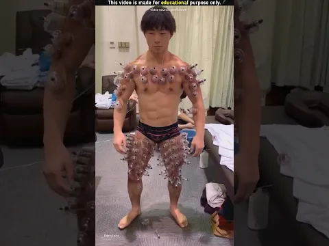 "Don't Panic! This Isn't Magic, It's Ancient Cupping Therapy!"