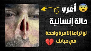أغرب حالة إنسانية لن تراها إلا مرة واحدة في حياتك سبحان الله 😱💔