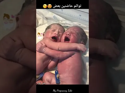 توائم حديثي الولادة متعلقين ببعض 😍😘
