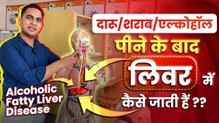 FullVideo-दारू/शराब/एल्कोहॉल पीने के बाद वो लिवर में कैसे जाती हैं | Alcoholic Fatty Liver Disease