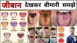 बीमारियां | Tongue colour | Disease | Disease identification | Types of Diseas | Infection | Doctor