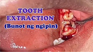 TOOTH EXTRACTION: Pulp Polyp 🦷