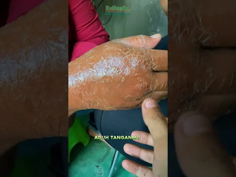 ASAL COLOK TANGAN MELEPUH BROK!