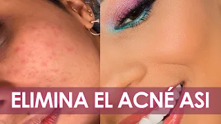 ASI ELIMINÉ EL ACNÉ - RUTINA+TIPS