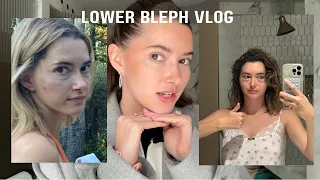 I got plastic surgery!! Lower blepharoplasty vlog