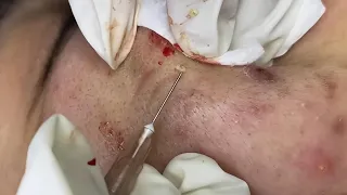 Deep Blackheads Removal from Cheeks and Nose | Best Pimple Popping Video #003 
